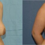 Breast Lift #6 - Before and After