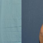 Breast Lift #6 - Before and After