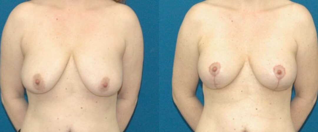 Breast Lift #7