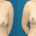 Breast Lift #7 - Before and After