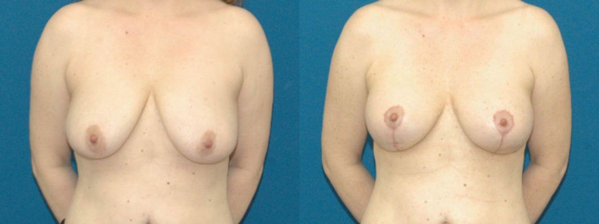 Breast Lift #7 - Before and After