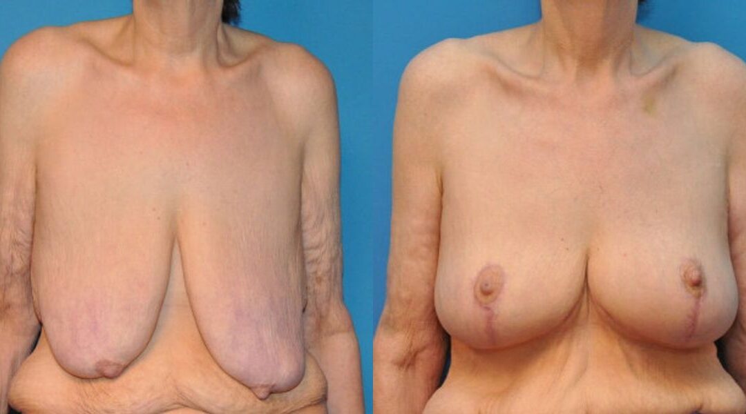 Breast Lift #8