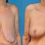 Breast Lift #8 - Before and After