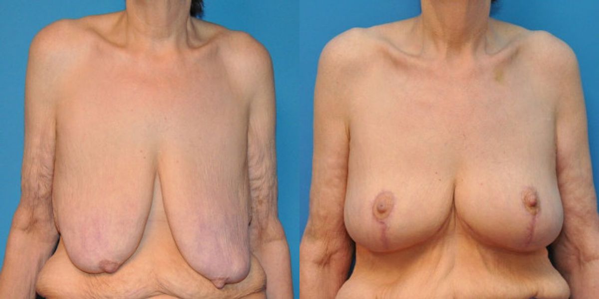 Breast Lift #8 - Before and After