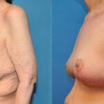 Breast Lift #8 - Before and After