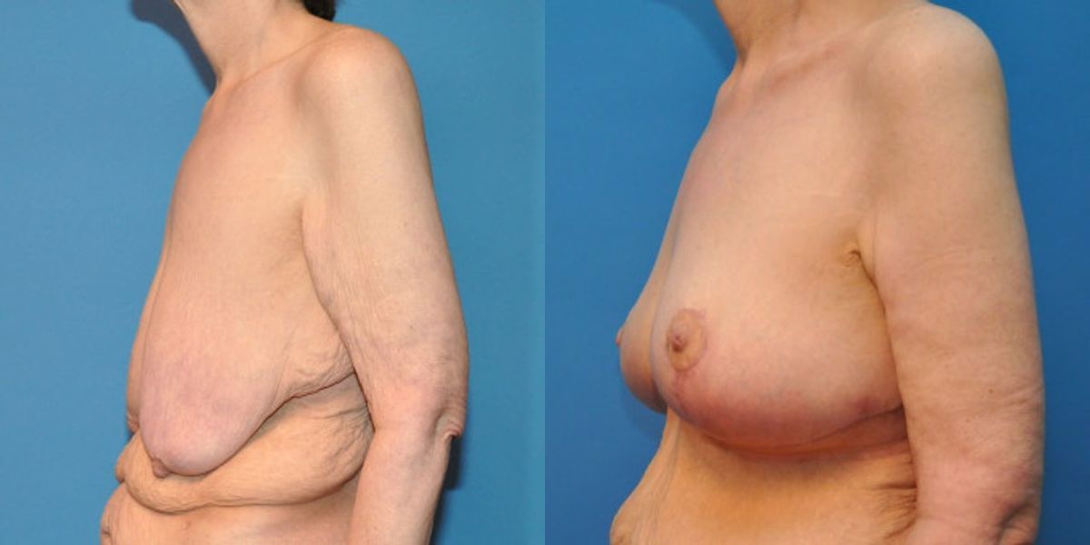Breast Lift #8 - Before and After