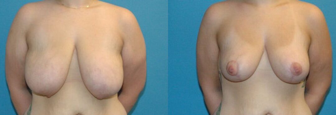 Breast Lift #9