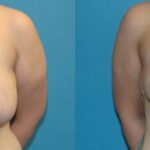Breast Lift #9 - Before and After