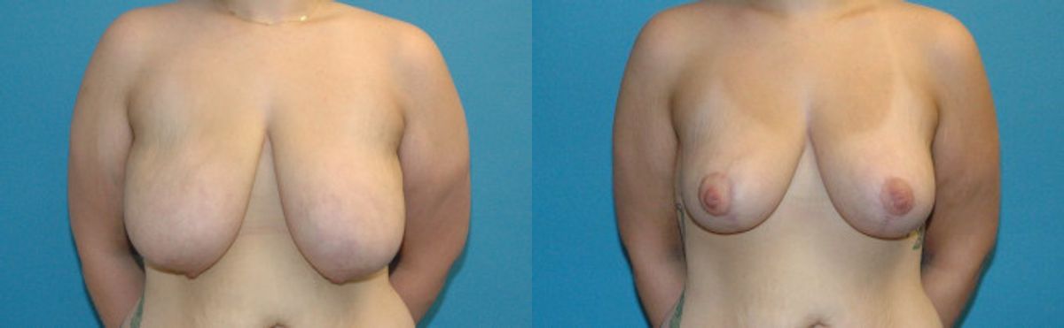 Breast Lift #9 - Before and After