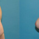 Breast Lift #9 - Before and After
