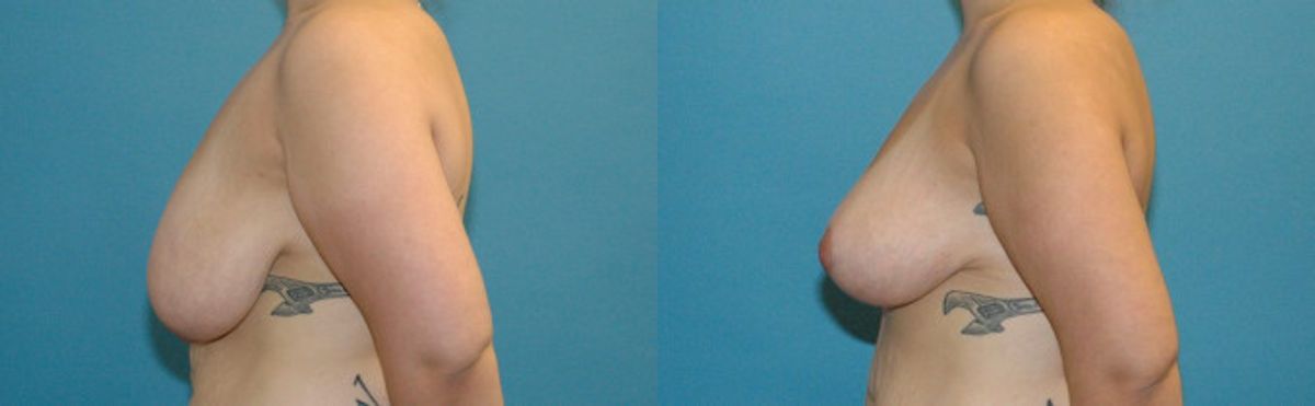 Breast Lift #9 - Before and After