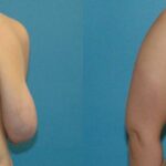Breast Lift #9 - Before and After