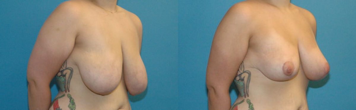 Breast Lift #9 - Before and After