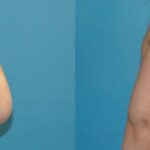 Breast Lift #9 - Before and After