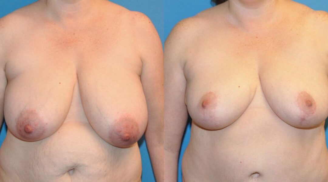 Breast Lift #10