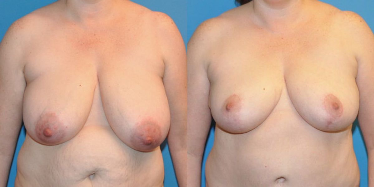 Breast Lift #10 - Before and After