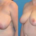 Breast Lift #10 - Before and After