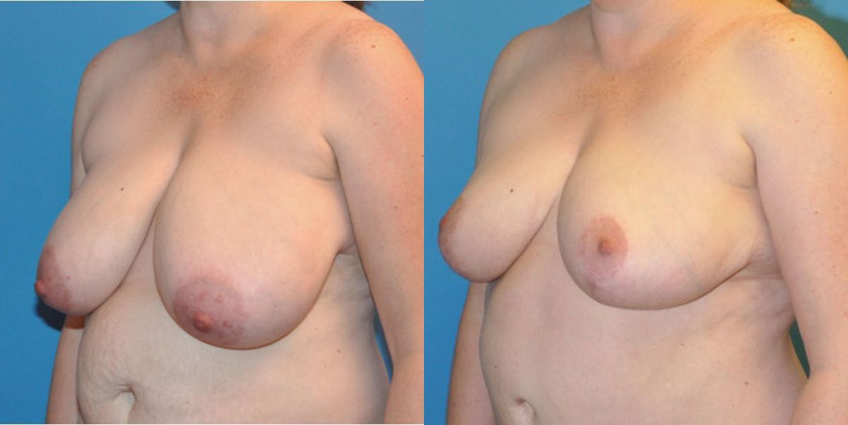 Breast Lift #10 - Before and After