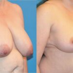 Breast Lift #10 - Before and After