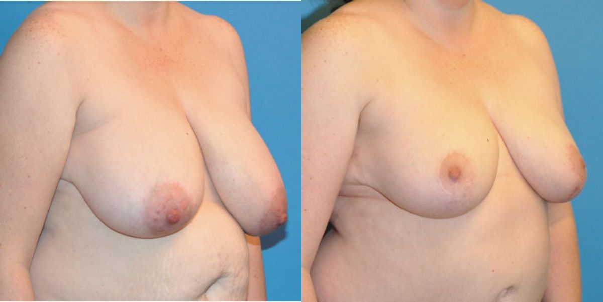 Breast Lift #10 - Before and After