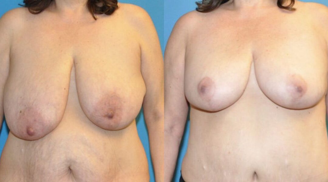 Breast Lift #11