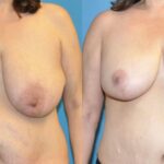Breast Lift #11 - Before and After