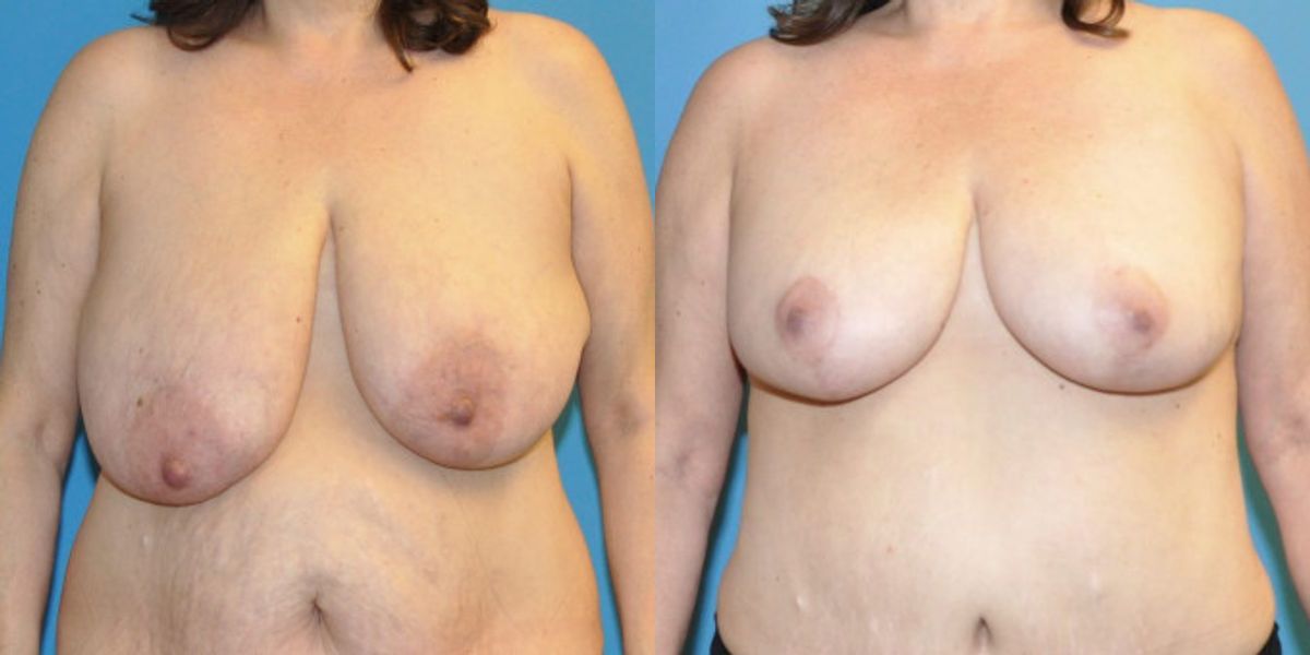 Breast Lift #11 - Before and After