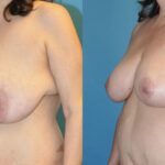 Breast Lift #11 - Before and After