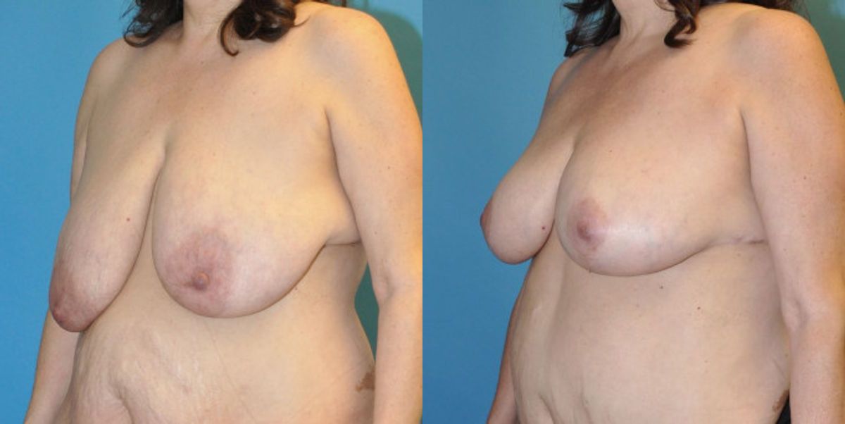 Breast Lift #11 - Before and After