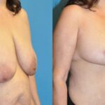 Breast Lift #11 - Before and After