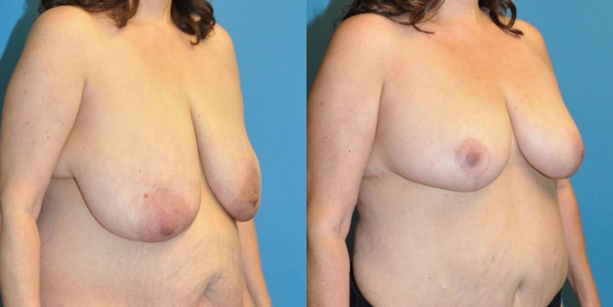 Breast Lift #11 - Before and After