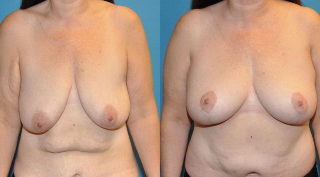 Breast Lift #12