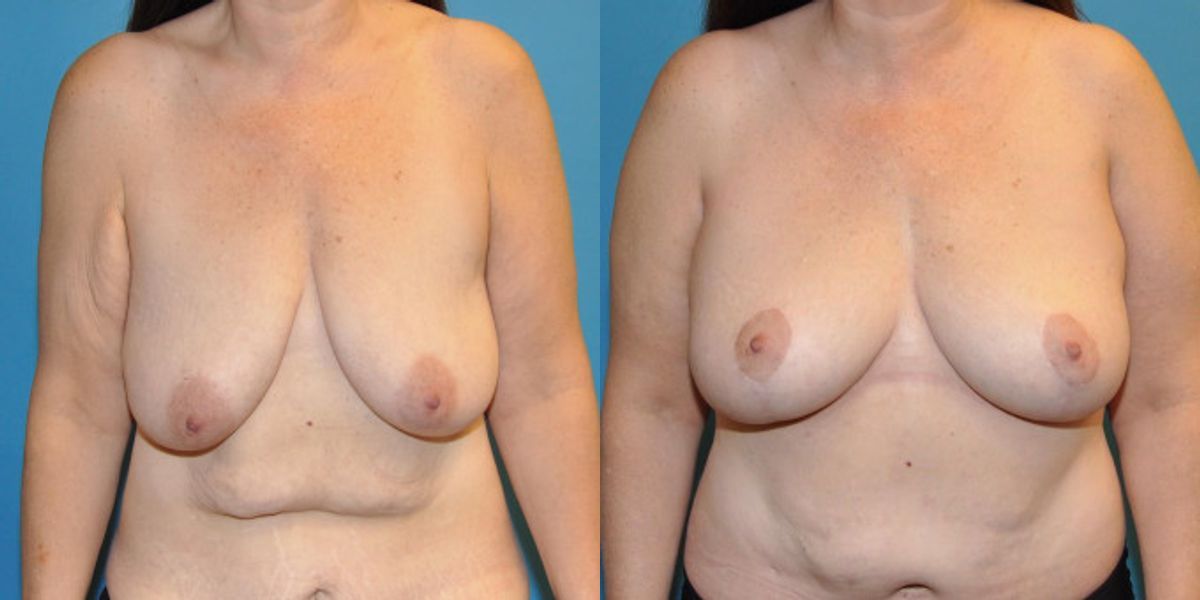 Breast Lift #12 - Before and After