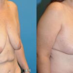 Breast Lift #12 - Before and After