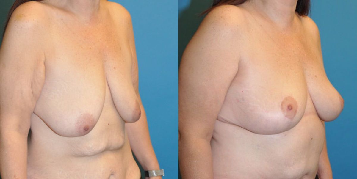 Breast Lift #12 - Before and After