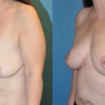 Breast Lift #12 - Before and After