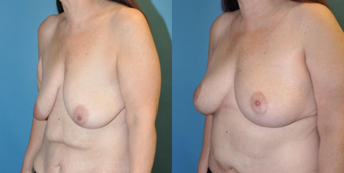 Breast Lift #12 - Before and After