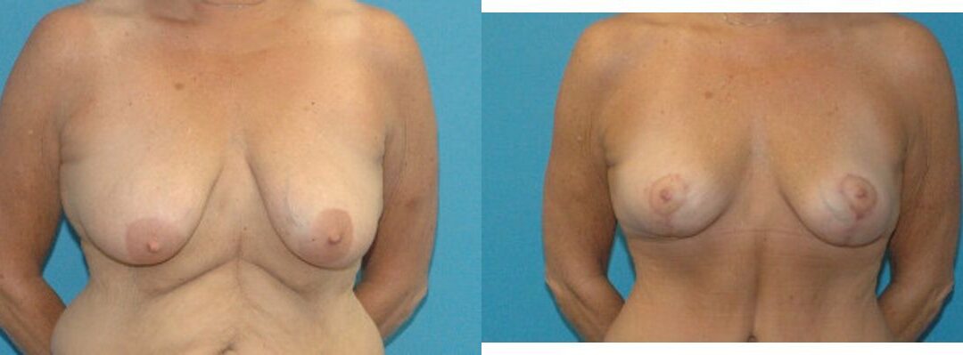 Breast Lift #13