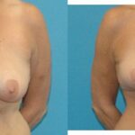 Breast Lift #13 - Before and After