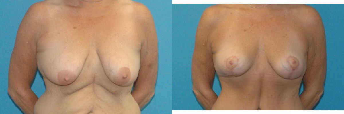 Breast Lift #13 - Before and After