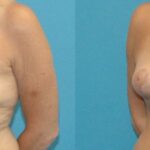 Breast Lift #13 - Before and After