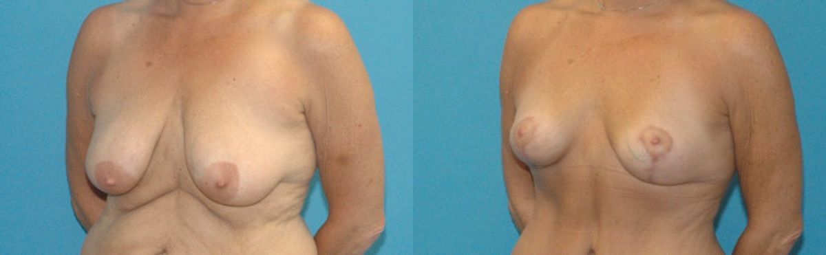 Breast Lift #13 - Before and After