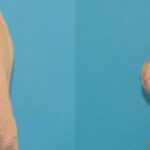 Breast Lift #13 - Before and After