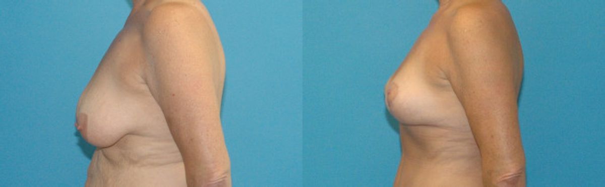 Breast Lift #13 - Before and After