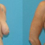 Breast Lift #13 - Before and After