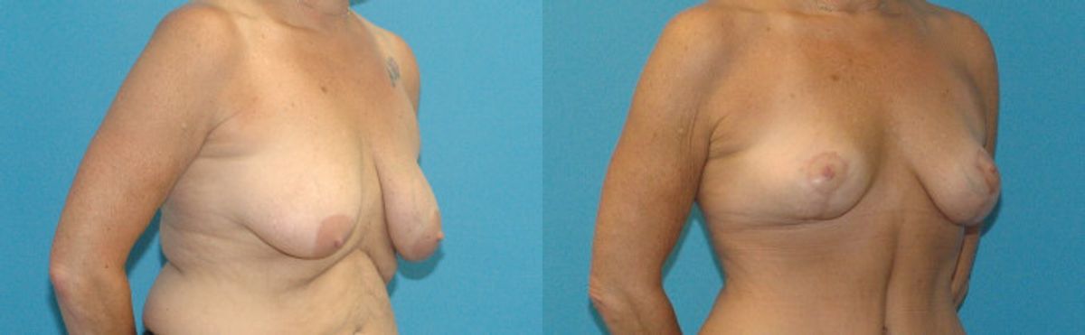 Breast Lift #13 - Before and After