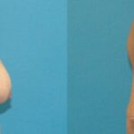 Breast Lift #13 - Before and After
