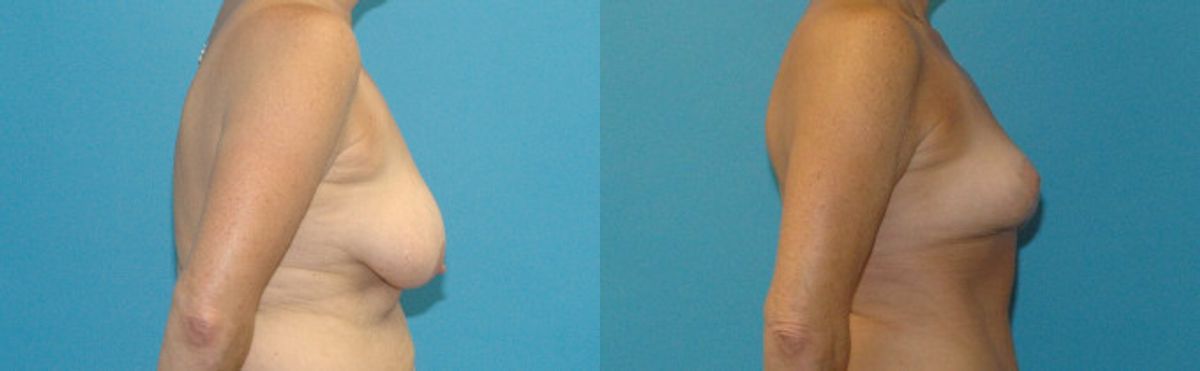 Breast Lift #13 - Before and After