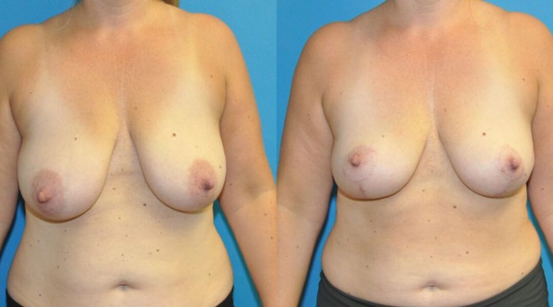 Breast Lift #14