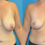 Breast Lift #14 - Before and After
